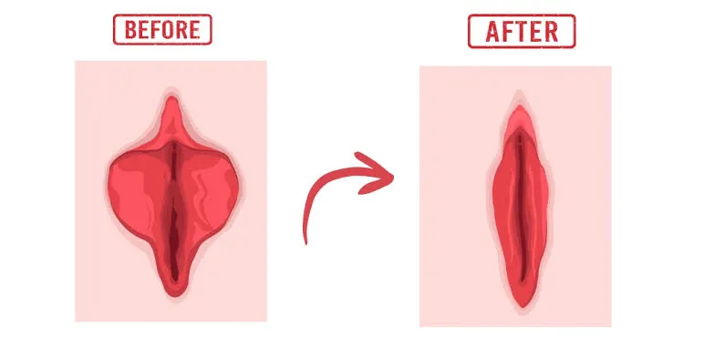Vagina Tightening