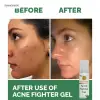 Cheek And Chin Acne Fighter Gel thumbnail
